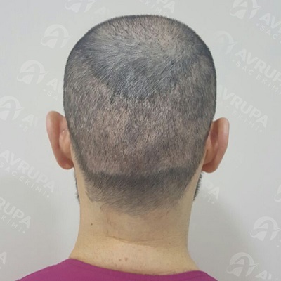 What is the Timeline for Hair Growth After Undergoing Hair Transplant