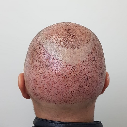 Itching After Hair Transplant: The What, Why & How? | ClinicAdvisor®