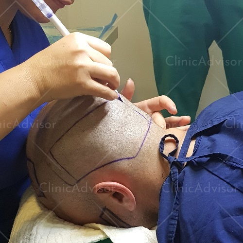 A person choosing the right hair transplant surgeon