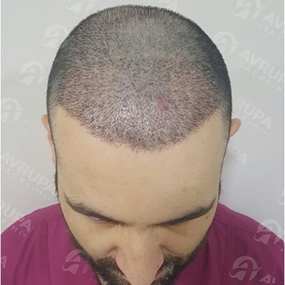 Hair Transplant Results Month by Month | ClinicAdvisor