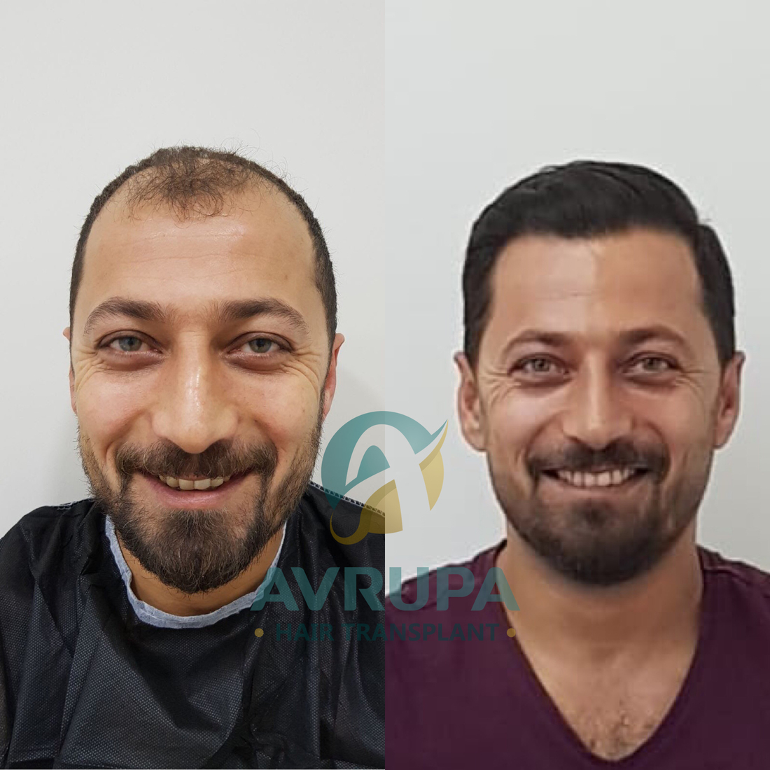 FUE Hair Transplant Results : 10 Real Cases With Photos - Clinic Advisor