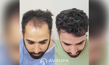 First Hair Transplant DISCOUNT of the year 2022!!