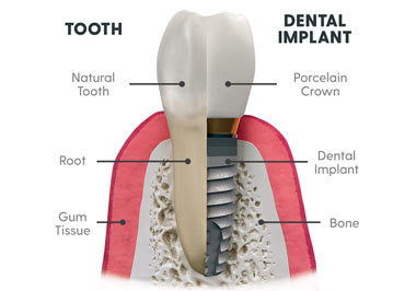 Dental Implants - from $1000 to $4000