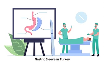 Everything You Need to Know About Gastric Sleeve in Turkey