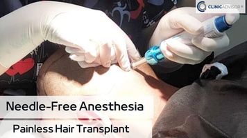 Needle Free Anaesthesia in FUE Hair Transplantation