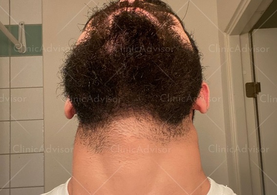 All About Minoxidil for Beard Growth & a REAL Experience With Photos |  ClinicAdvisor®