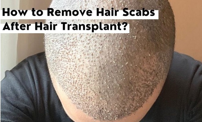 When and How to Get Rid of Scabs After Hair Transplant?