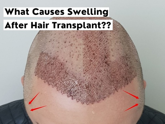 Causes of Swelling After Hair Transplant and Ways to Reduce It