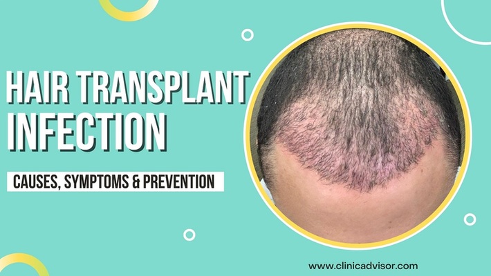 What Causes Hair Transplant Infection and How to Prevent it?