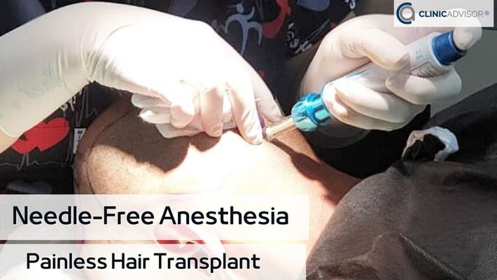 Needle-Free Anesthesia: Painless Hair Transplant | ClinicAdvisor®