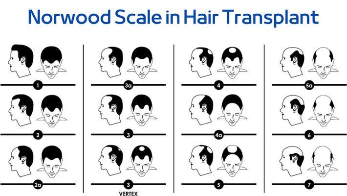 Norwood Scale in Hair Transplant