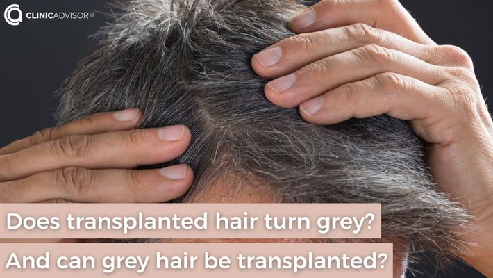 Does Transplanted Hair Turn Grey? And Can Grey Hair be Transplanted?