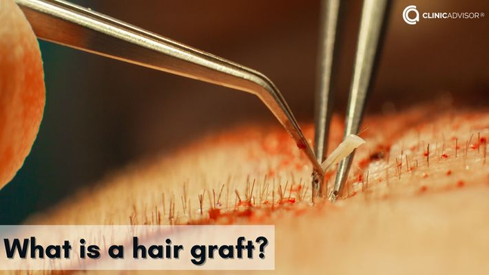 What is a hair graft?