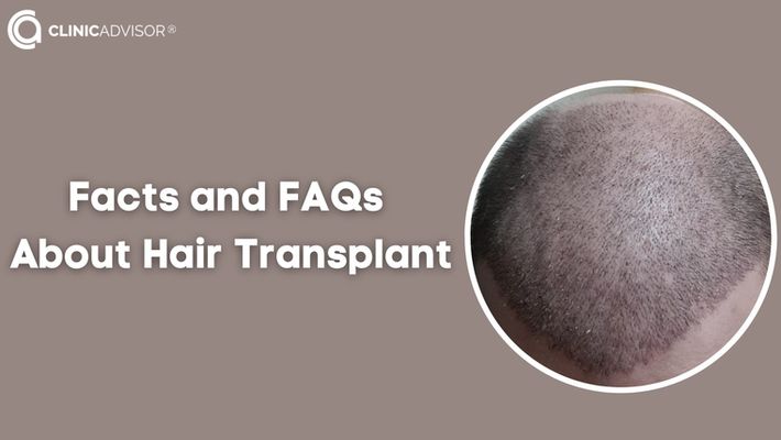 Frequently Asked Questions About the Transplanted Hair