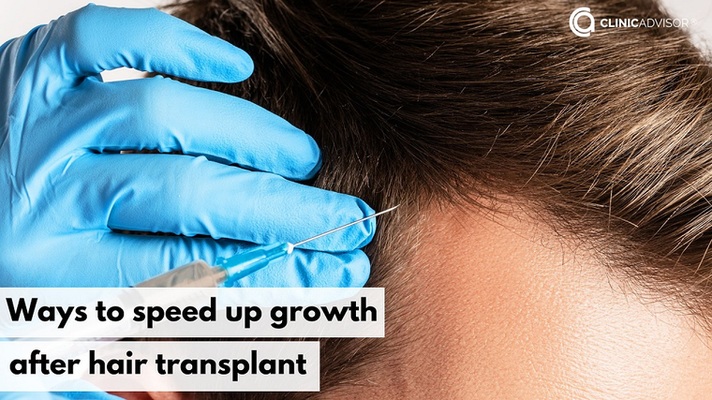 How to Speed Up Hair Growth After Hair Transplant