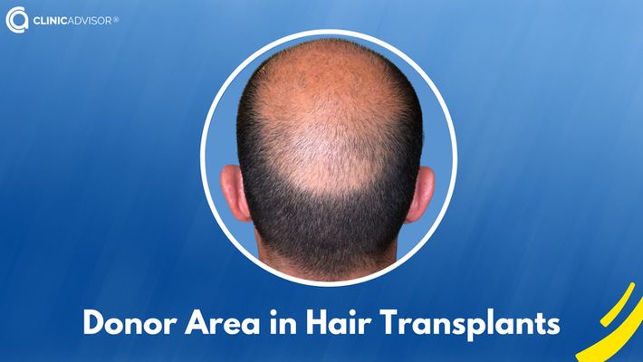 What is the donor area in hair transplants?