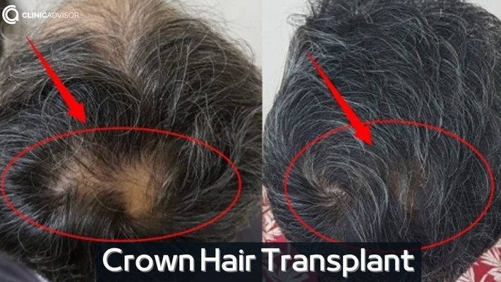 Bald Spot On Crown Causes Ways To Hide  Treatments  Longevita