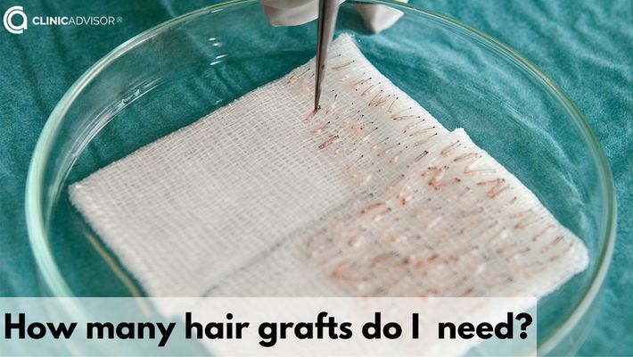 How many hair grafts do I need for a hair transplant?