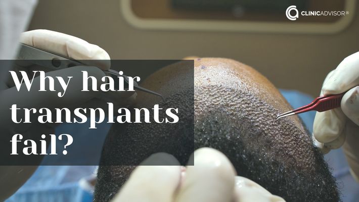 Why do some hair transplants fail?