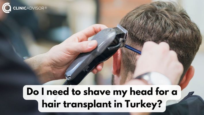 Do You Have to Shave Your Head for a Hair Transplant in Turkey?
