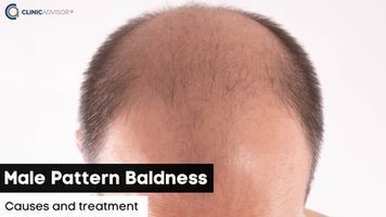 What is Male Pattern Baldness and Can it be Treated?