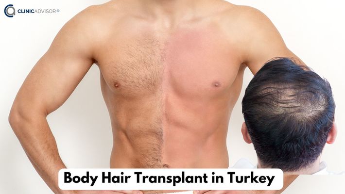 Body Hair Transplant in Turkey