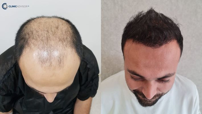 I Tried it and This is Why Hair Transplant is Better in Turkey