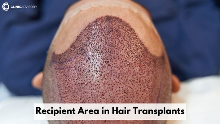 What is the Recipient Area in Hair Transplants?