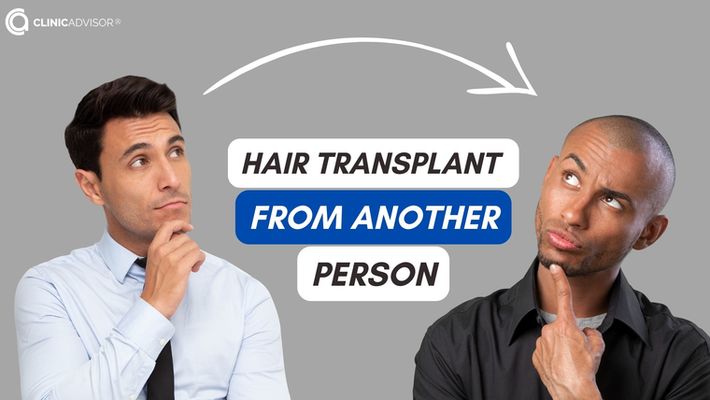 Can hair be transplanted from one person to another?