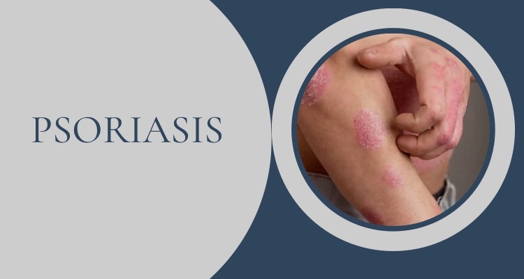 Psoriasis:  Dermatologist Answers The Most Common Questions