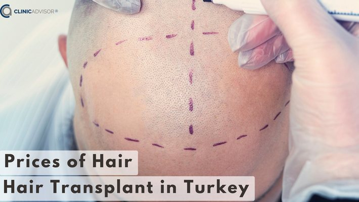 Prices of Hair Transplants in Turkey - 2024 ( Fue, DHI, Sapphire)