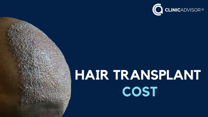 Hair Transplant Cost: Unveiling the Price of Hair Restoration