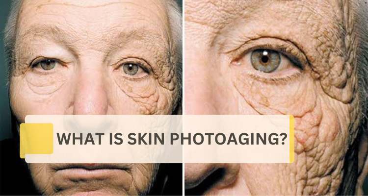 What is Photoaging (Sun Damage) of the Skin?