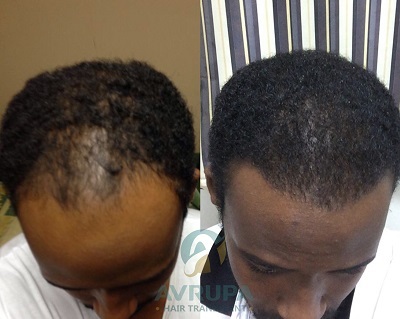 Afro Hair Transplant Story: With All The Details