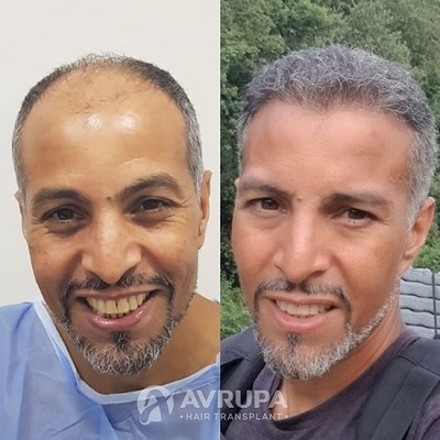 Hair Transplant Final Results : With All The Details !