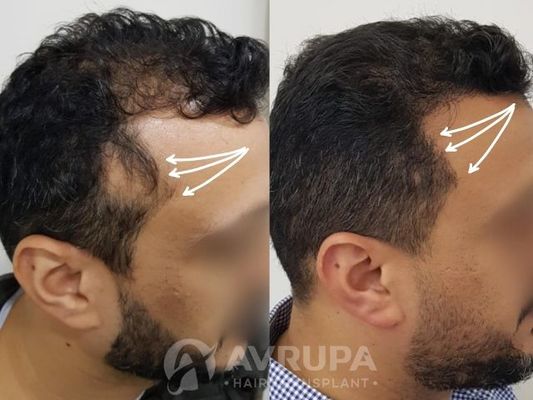 Does Hair Transplant on Scar Really Work? Here's The Answer