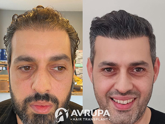 A Botched Hair Transplant Fixed Naturally by Avrupa Hair Transplant Clinic in Istanbul