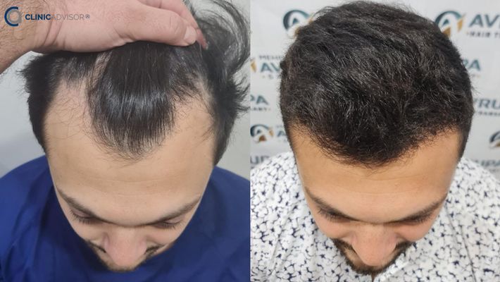 I have Tried Hair Transplant in Turkey and Thank God for the Great Results