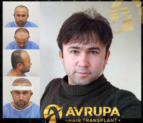 How is a Hair Transplant Done and How Long Does it Take?