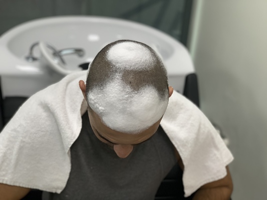 A Complete Guide on How to Wash Your Hair After Hair Transplant
