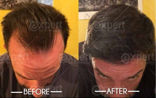 Fixing a receeding hairline with a DHI hair transplant | ClinicAdvisor
