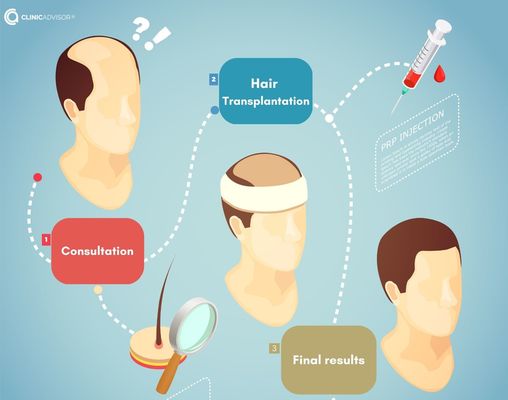 Hair Transplant Stages