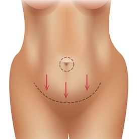 Tummy Tuck Scar: types, healing and expectations
